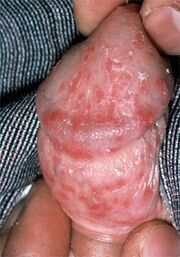 out of the penis due to thrush